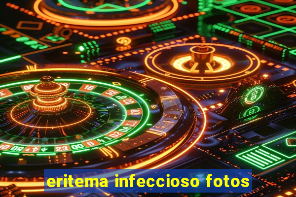 eritema infeccioso fotos